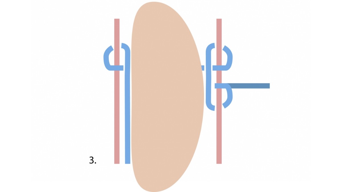How to crimp a macrame stone? : Step 3 How to crimp a macrame stone? : Step 3